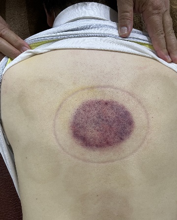 「拔罐後印記」1-1