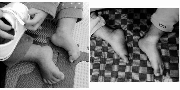 圖二:患者足部畸形的症狀經過治療後明顯改善