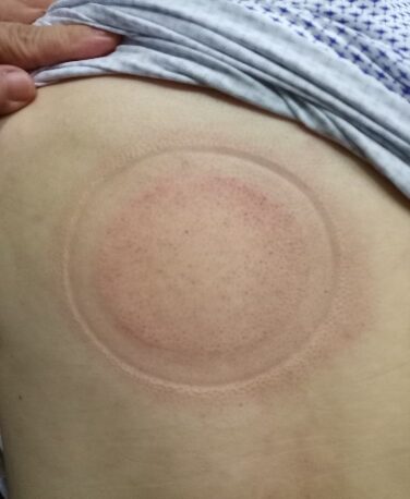 「拔罐後印記」1-2