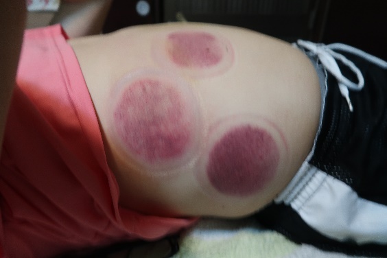 「拔罐後印記」2
