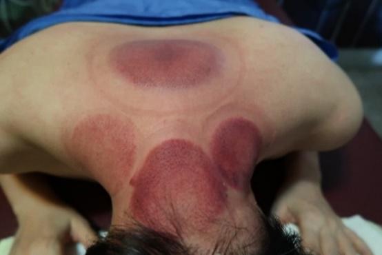 「拔罐後印記」3-1