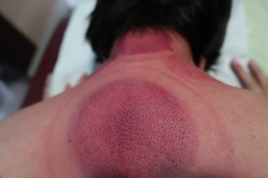 「拔罐後印記」3-2