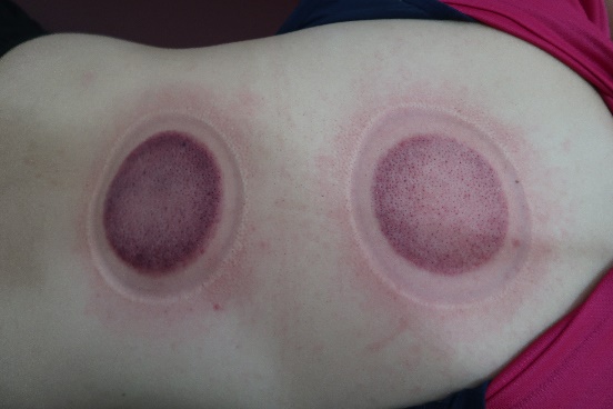 「拔罐後印記」3-2