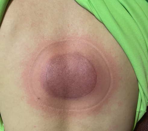 「拔罐後印記」3-3