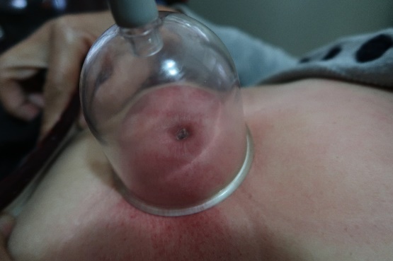 「拔罐後印記」4-1