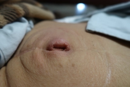 「拔罐後印記」4-2