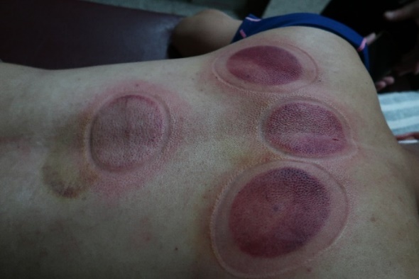 「拔罐後印記」5