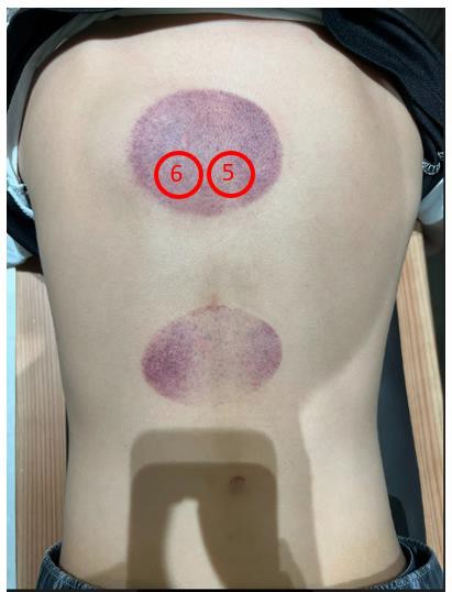 穴壓治療長新冠肺炎後遺症的原理3