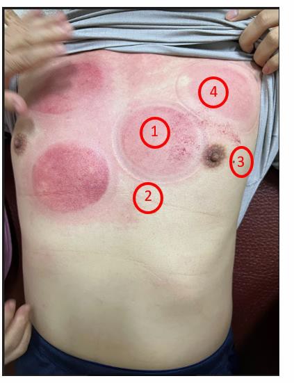 穴壓治療長新冠肺炎後遺症的原理2