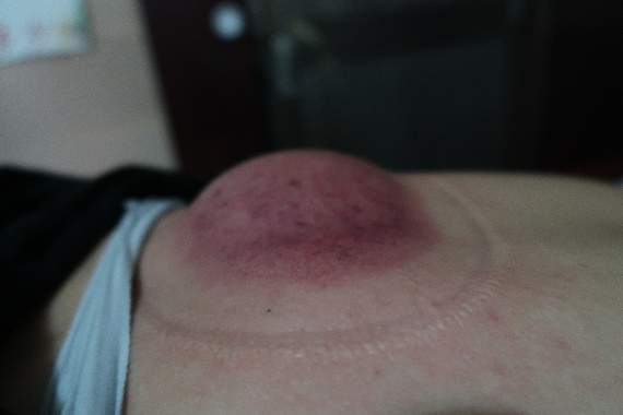 「拔罐後印記」7-2