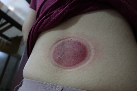 「拔罐後印記」8