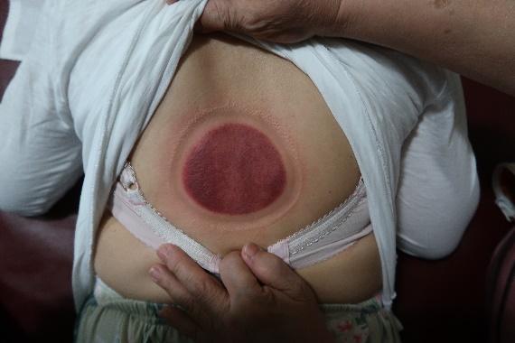 「拔罐後印記」9