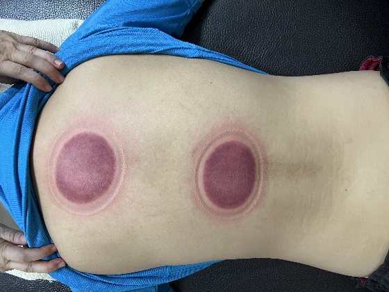 「拔罐後印記」10