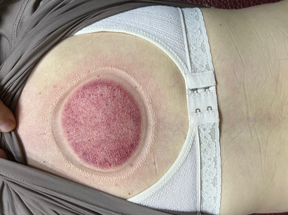 「拔罐後印記」11-1