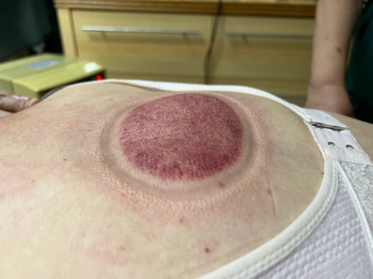 「拔罐後印記」11-2