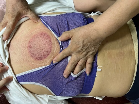 「拔罐後印記」12-1-1