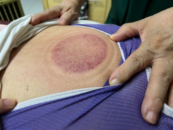 「拔罐後印記」12-1-2