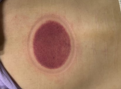 「拔罐後印記」12-2-1