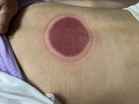 「拔罐後印記」12-2-2