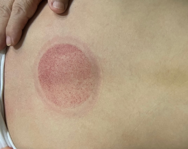 「拔罐後印記」12-3-1