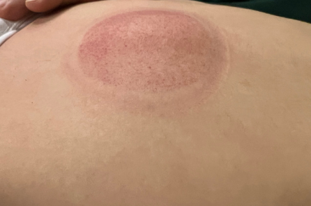 「拔罐後印記」12-3-2