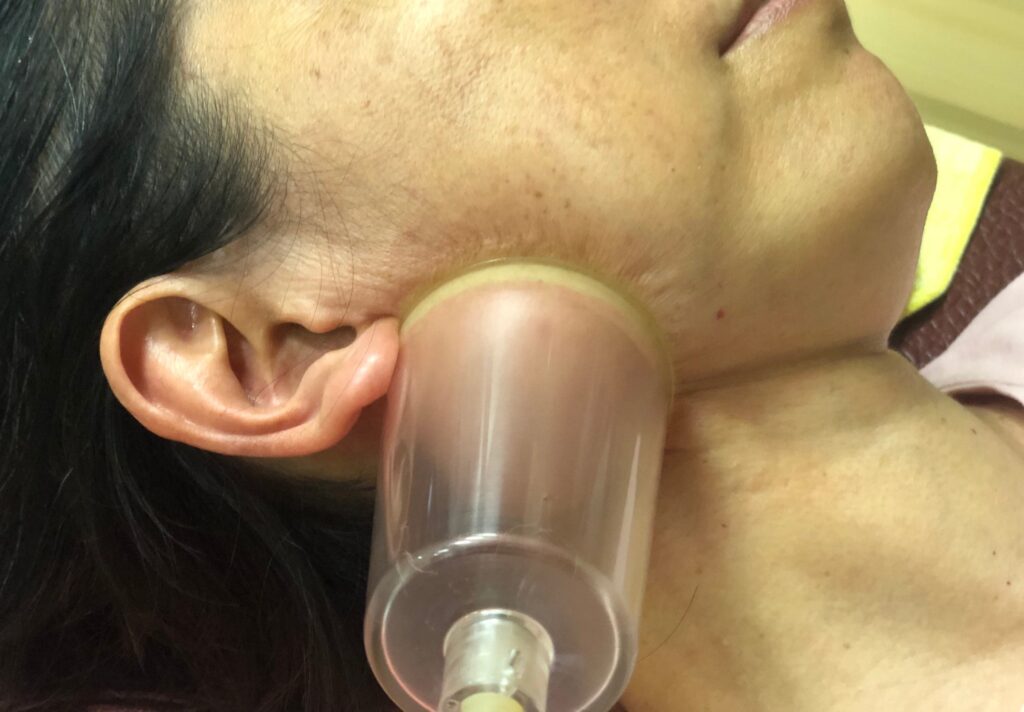 顳顎關節障礙個案報告5