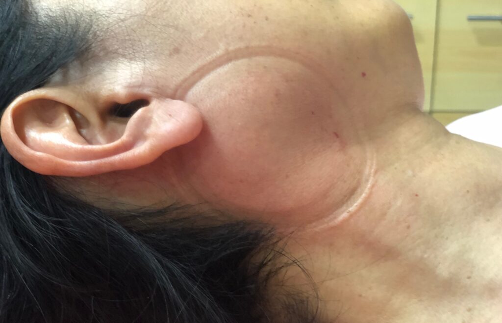 顳顎關節障礙個案報告6