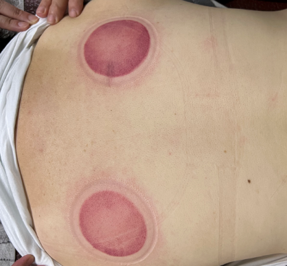 「拔罐後印記」13