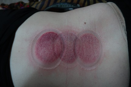 「拔罐後印記」14-1