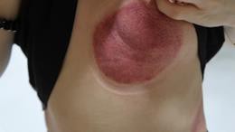 成人感染新冠10