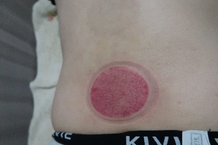 「拔罐後印記」14-2