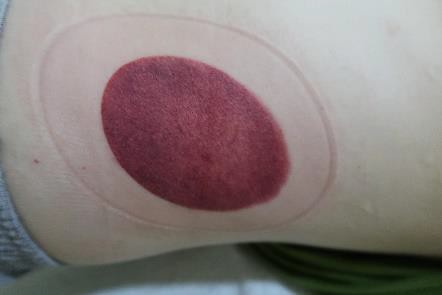 成人感染新冠11