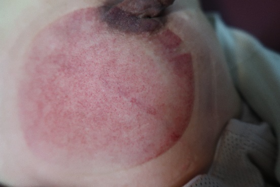 「拔罐後印記」15-1