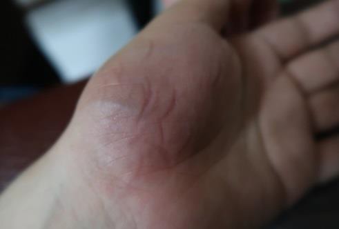 大姆指手機症候群2