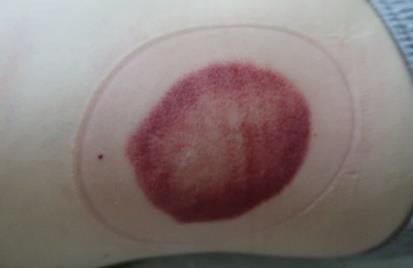 成人感染新冠12