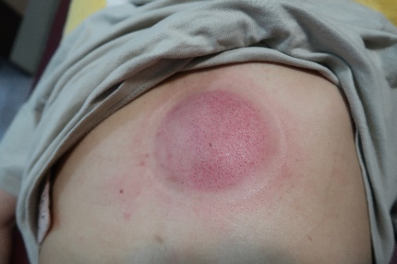 「拔罐後印記」15-2