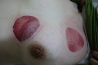 成人感染新冠13