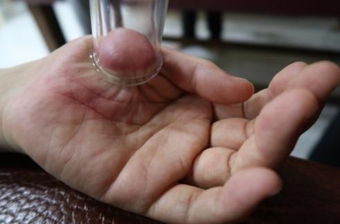 大姆指手機症候群3