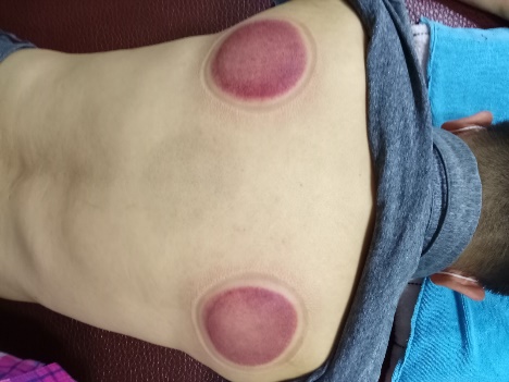 「拔罐後印記」17