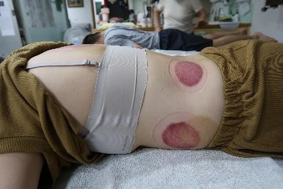 成人感染新冠15