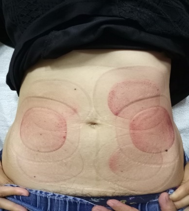 「拔罐後印記」18