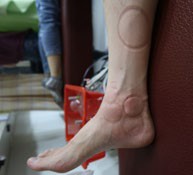 足踝損傷疼痛3-1