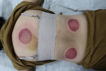 成人感染新冠17