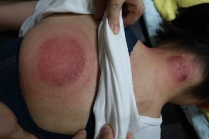 成人感染新冠18