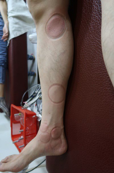 足踝損傷疼痛3-3