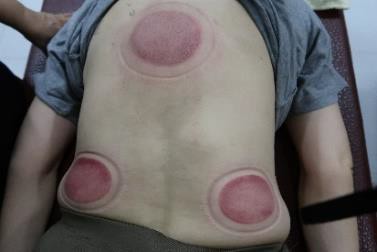 成人感染新冠20