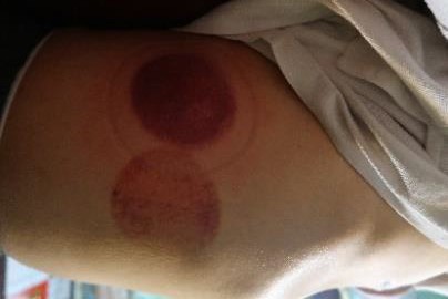 成人感染新冠21