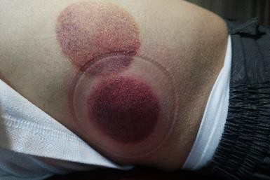 成人感染新冠22