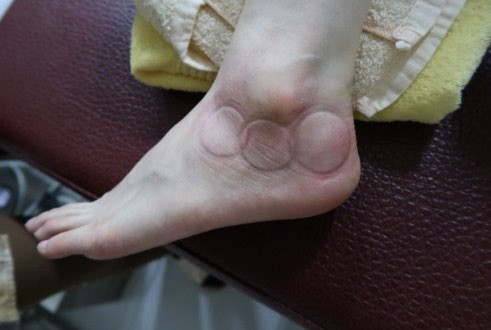 足踝損傷疼痛3-2-1