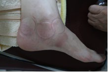 足踝損傷疼痛3-2-2